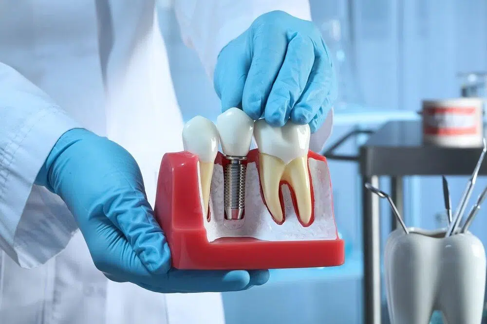 Unlocking Holland Park's Dental Implant Costs: Strategies for Affordability