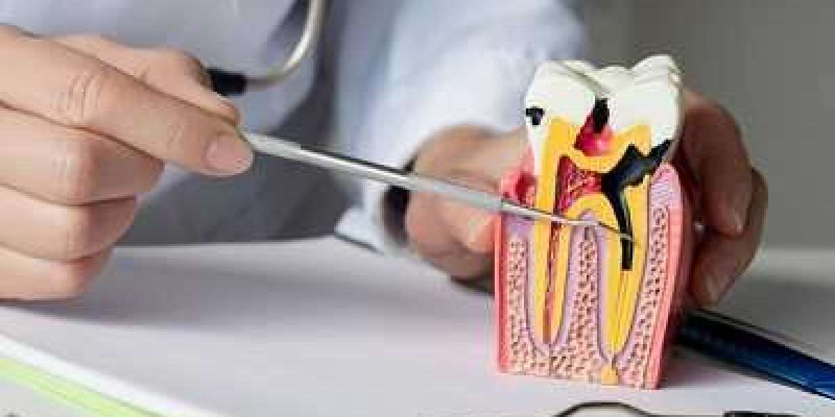 Pain Management During Root Canal Procedures