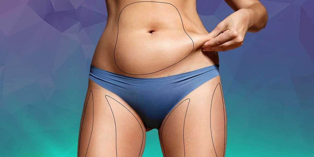 What to Do After Liposuction Procedure?