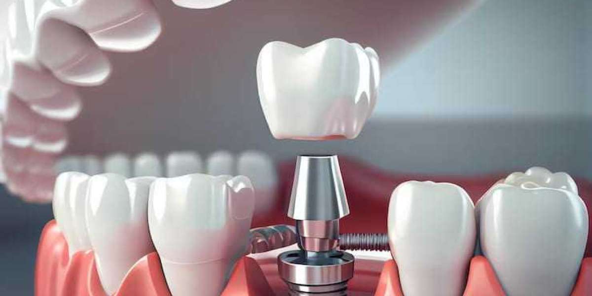 Everything You Need to Know About Dental Crowns: Benefits, Process, and Care